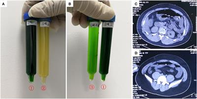 Case series: Diquat poisoning with acute kidney failure, myocardial damage, and rhabdomyolysis